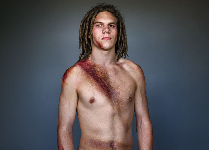10 Car Crash Survivors Pose Proudly For A Chilling Photo Project To Raise Awareness About Seatbelt Safety