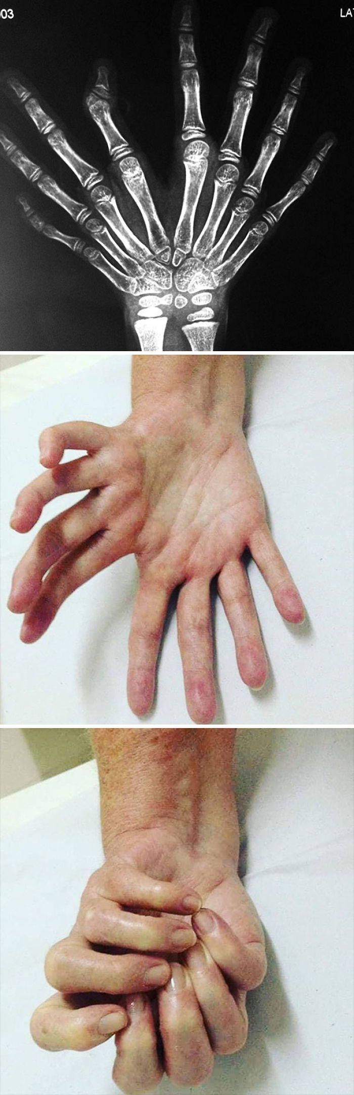 Síndrome de mano en espejo