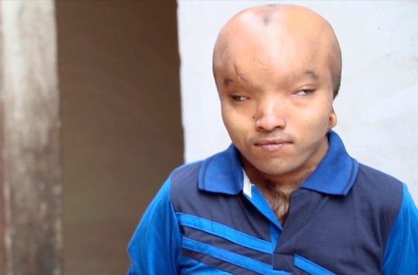 Dubbed As “Alien”, Man With Enlarged Head Disorder Wants Surgery So He Can Find Love