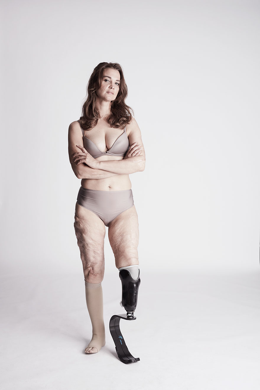 We Photographed 19 People With Limb Differences Aged From 2 To 54 In Body Confidence Shoot