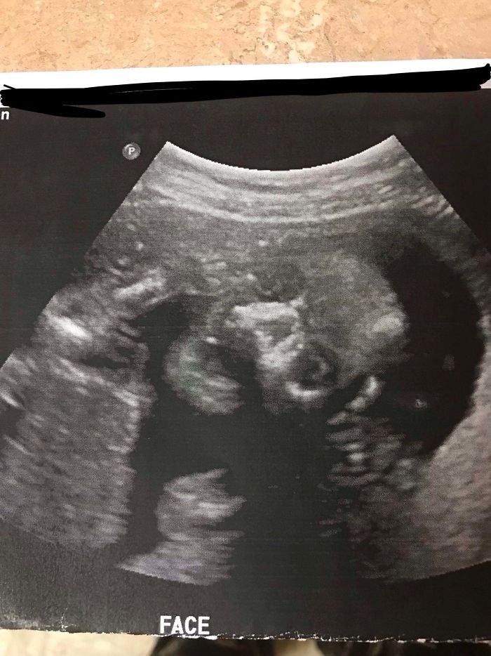 This Ultrasound Photo Scared My Husband