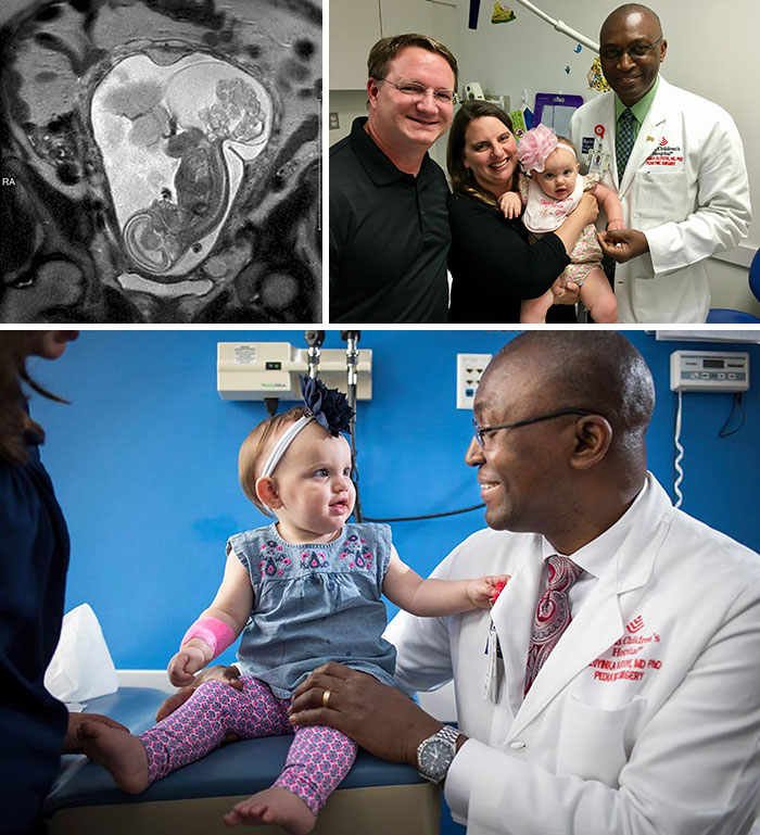 There Was A Huge Tumour On The Unborn Child. Dr Oluyinka Olutoye Was Able To Save The Baby’s Life By Delivering Her, Operating, And Then Putting Her Back In The Womb