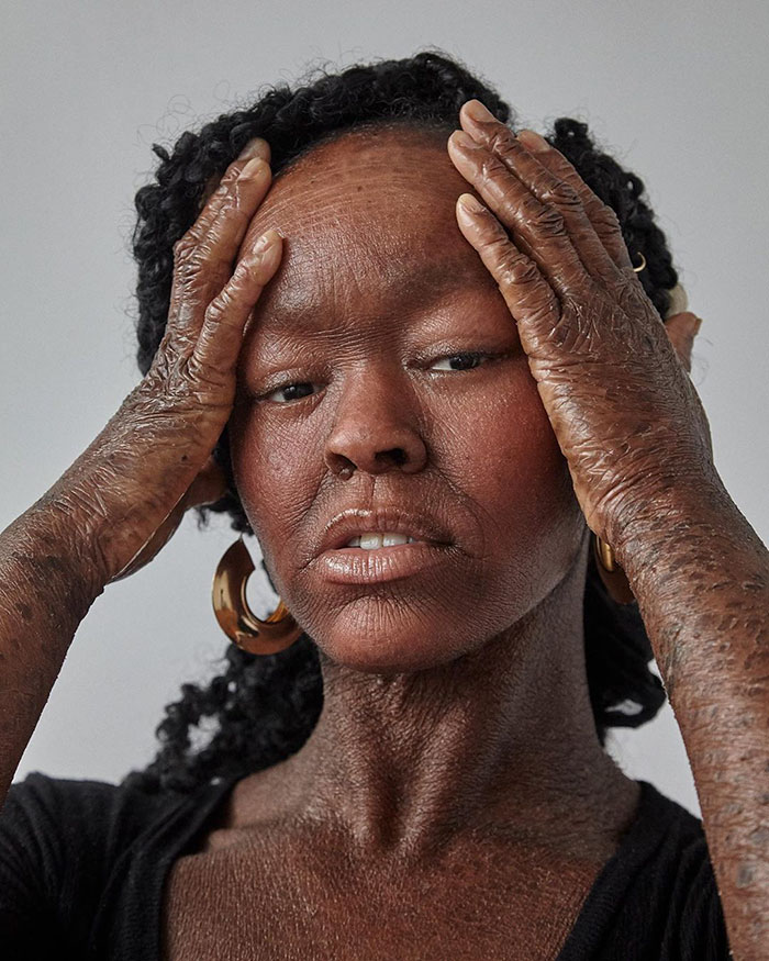 Woman Who Sheds Skin Every Two Weeks Becomes Probably The First Model Who Has This Condition