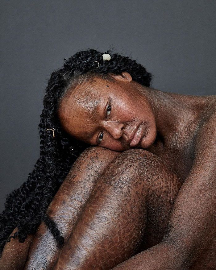 Woman Who Sheds Skin Every Two Weeks Becomes Probably The First Model Who Has This Condition