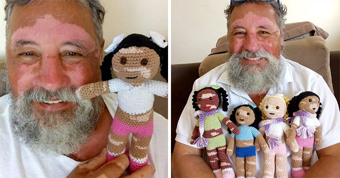 Grandfather With Vitiligo Crochets Dolls To Make Children With This Condition Feel Better