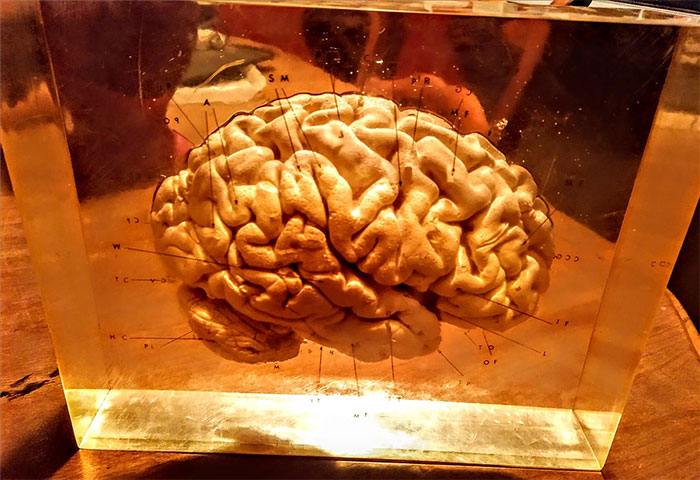 An Actual Human Brain Preserved In Resin. Hell Yes I Brought It Home! $6