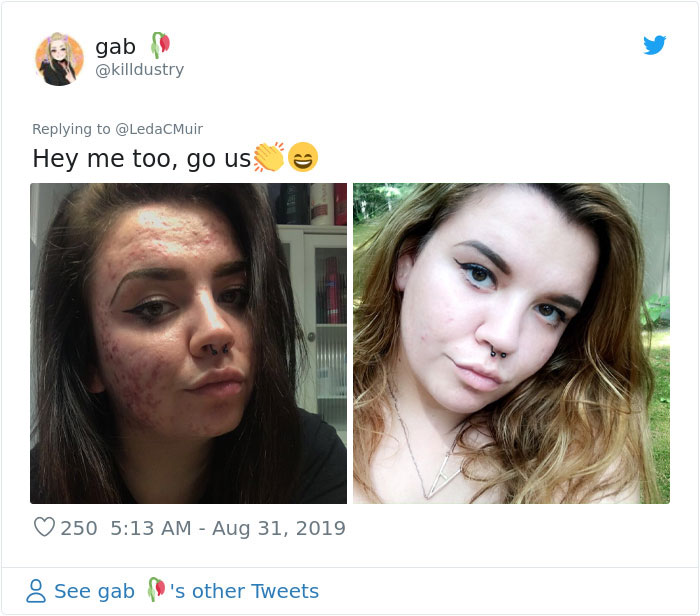 People Call This 25-Year-Old A Liar Because Of How Well She Cured Her Acne, So She Posts A Video To Prove It