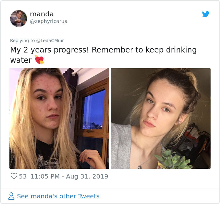 People Call This 25-Year-Old A Liar Because Of How Well She Cured Her Acne, So She Posts A Video To Prove It