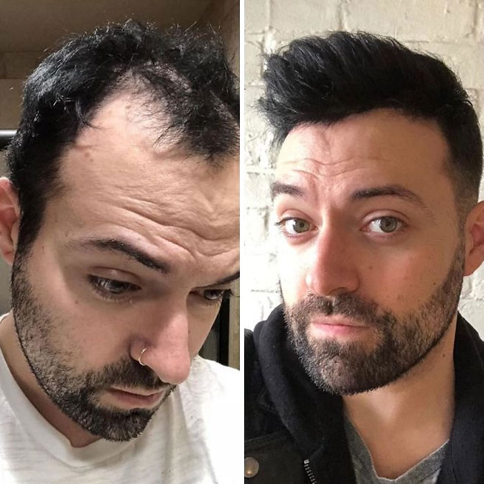 Before-After-Hair-Replacement-Phildoeshair