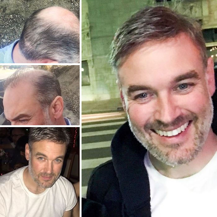 Before-After-Hair-Replacement-Phildoeshair