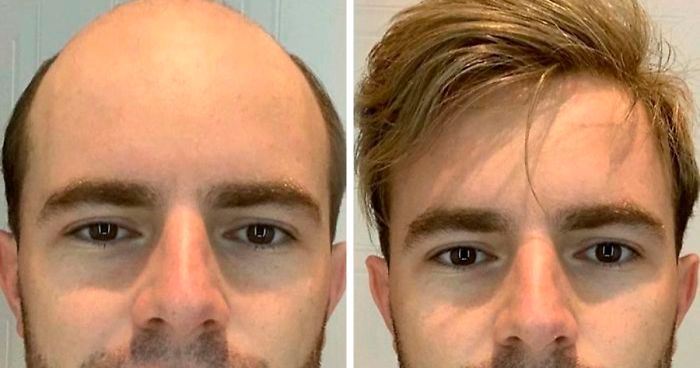 Balding Guys Try Out Non-Surgical Hair Replacements By Phil Ring, And Their  Smiles Say Everything (44 Pics) | Bored Panda