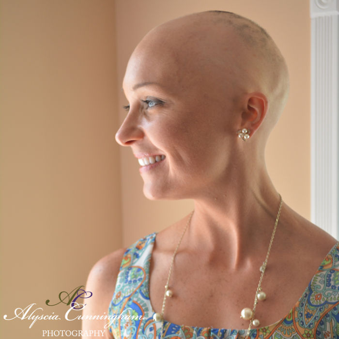 I'm Shedding Some Truth On Female Baldness: It's Not Always Cancer