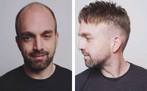 Balding Guys Try Out Non-Surgical Hair Replacements By Phil Ring, And Their Smiles Say Everything (44 Pics)