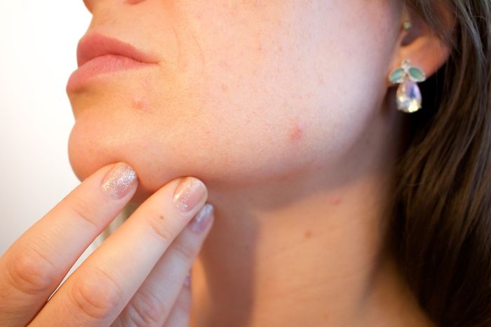 Acne Is Mostly Caused By Genetics