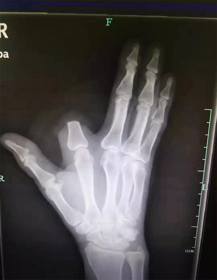 Chinese Man Chops Off His Own Finger After A Snake Bite ‘To Save My Own Life’, But Doctors Say It Was Totally Unnecessary