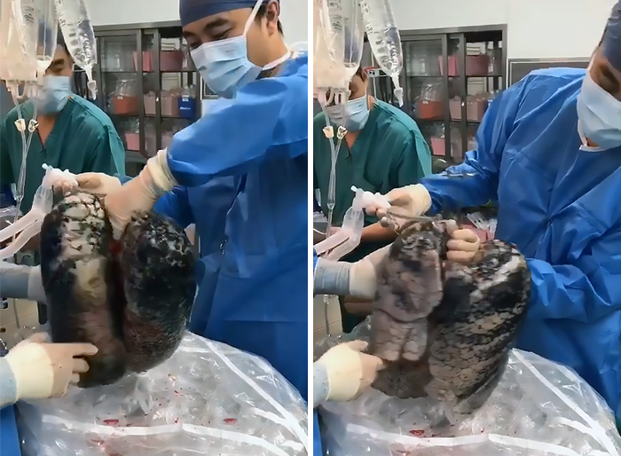 Surgeons Show What The Human Lungs Look Like After 30 Years Of Smoking & It's Shocking