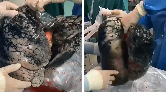 Surgeons Show What The Human Lungs Look Like After 30 Years Of Smoking & It’s Shocking
