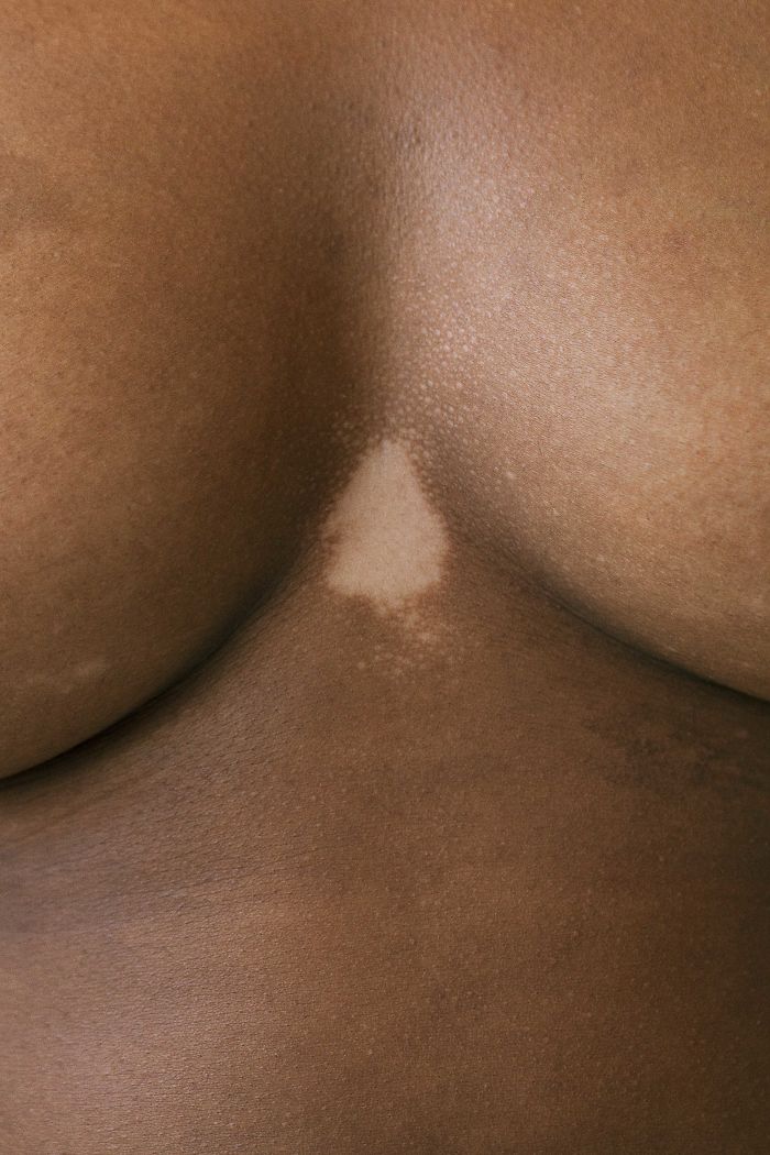 Vitiligo-Beauty-Photography-Elisabeth-Van-Aalderen