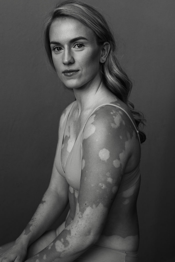 Vitiligo-Beauty-Photography-Elisabeth-Van-Aalderen