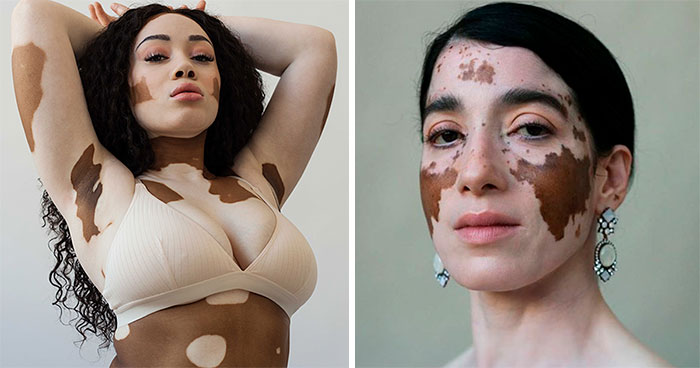 35 Beautiful Women With Vitiligo Shot By A Photographer Who Has The Same Condition