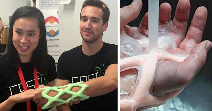Engineers Create A Breathable And Waterproof Cast To Replace Plaster Ones  And Stop The Itching Forever