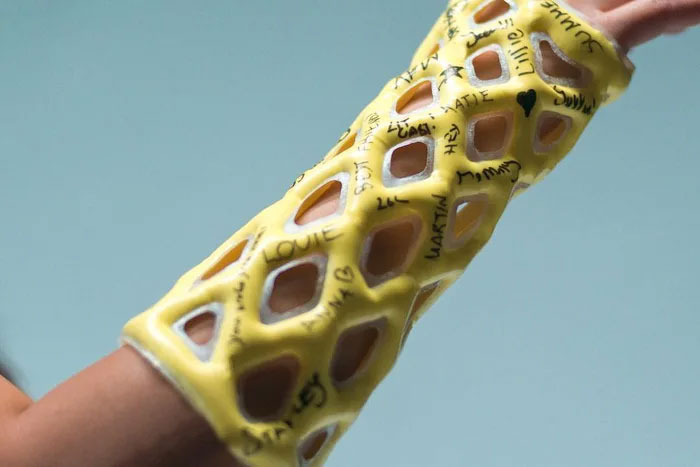 Engineers Create A Breathable And Waterproof Cast To Replace Plaster Ones And Stop The Itching Forever