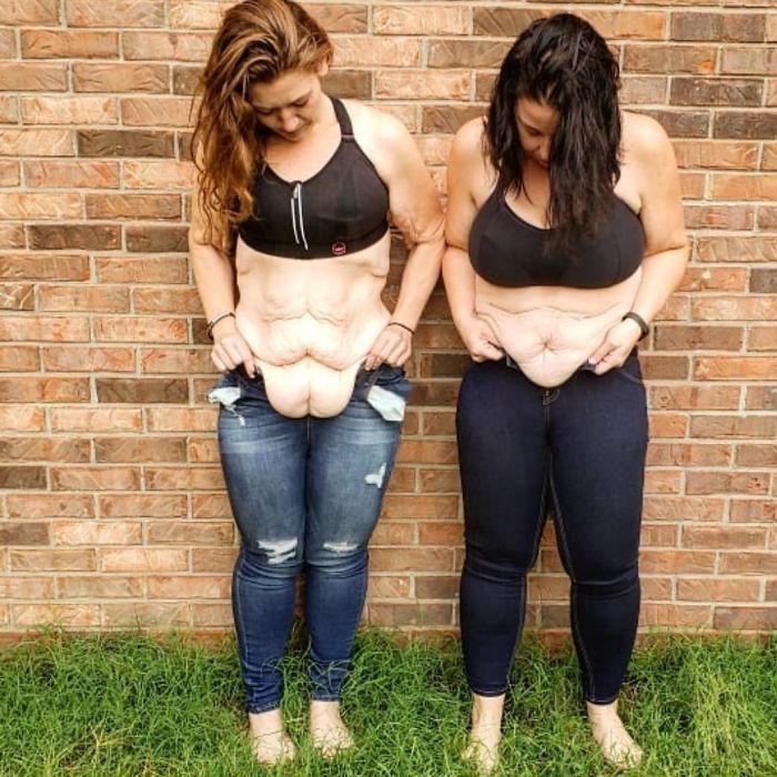 These Women Show The Realities Of Major Weight Loss 