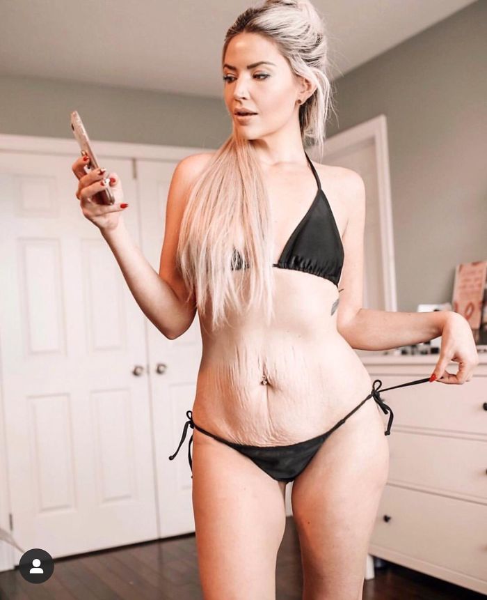 This Lady Proudly Shows Off Her Loose Skin, Scarring, And Cellulite. So Inspiring!