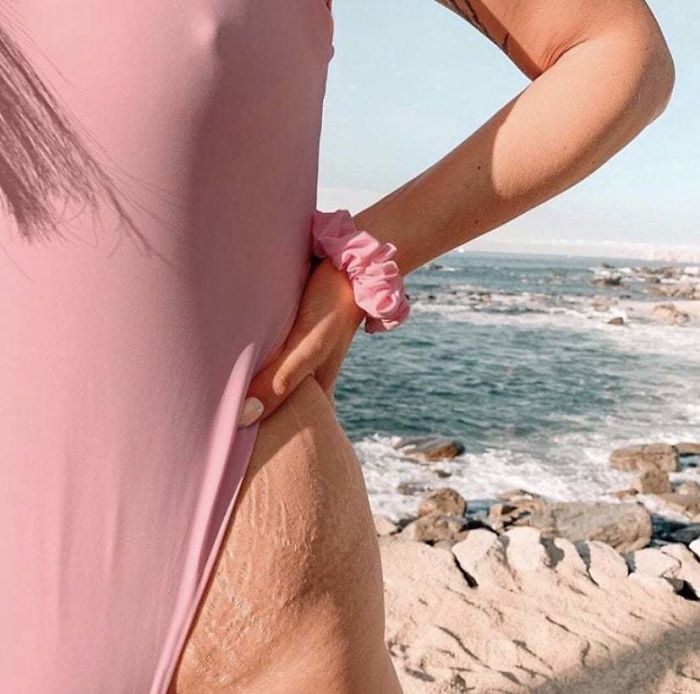 Body Positive Influencer Showing Off Her Stretch Marks