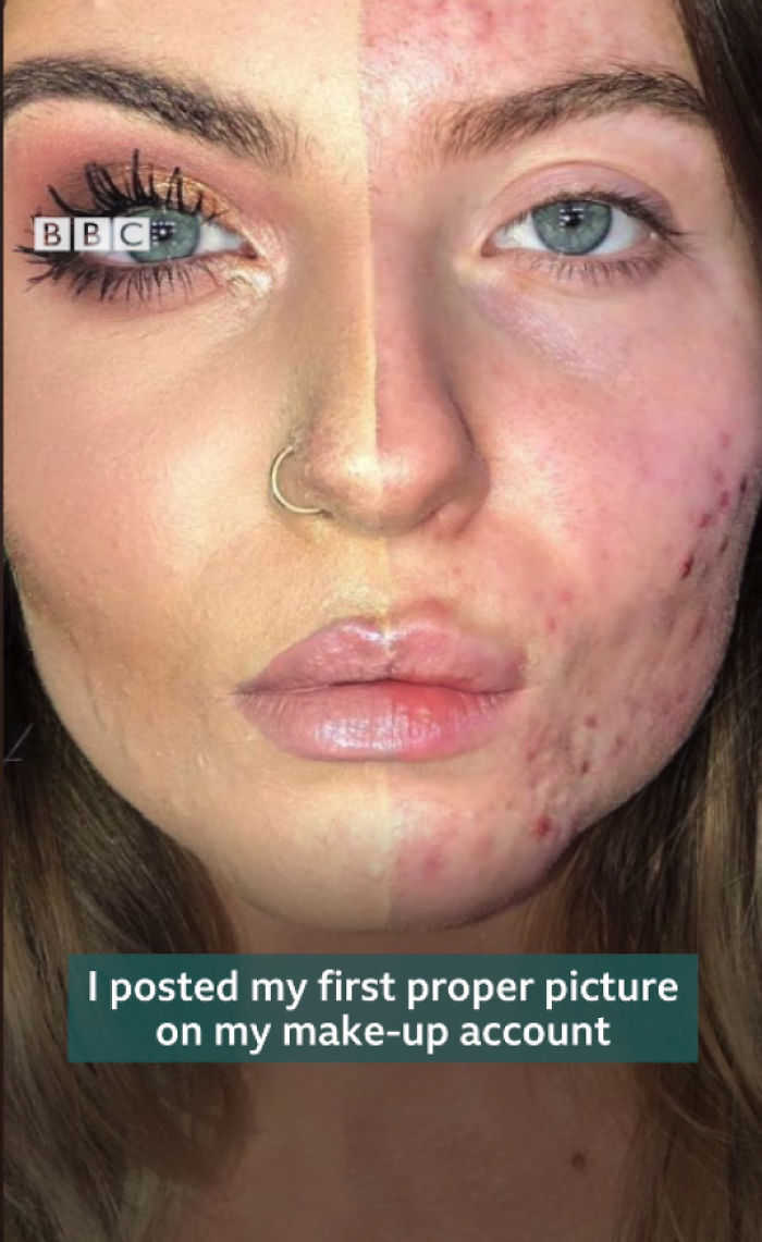 Makeup Artist With Cystic Acne Embraces Herself And Doesn't Edit Photos (Full Bbc Video In Comments)