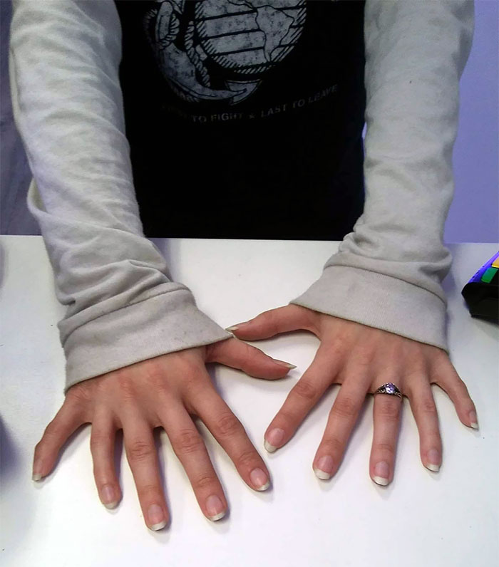 Customer Came In And Let Me Take A Picture Of Her Hands That Had 6 Fingers On Each