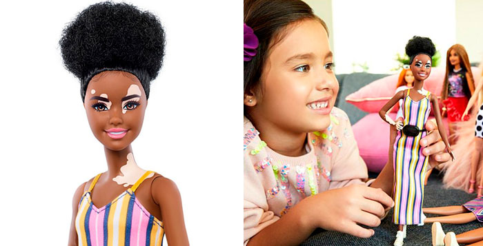 Barbie Celebrates Diversity By Creating Differently-Abled Dolls With Vitiligo And No Hair That Come In 35 Different Skin Tones
