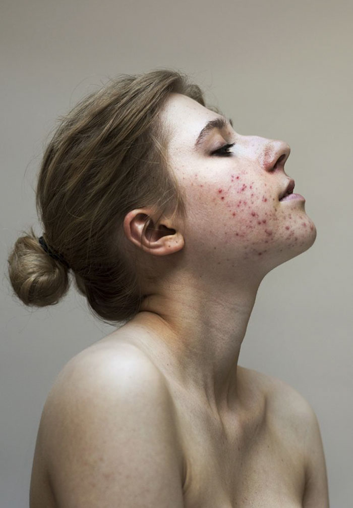 Women-Skin-Problems-Epidermis-Project-Sophie-Harris-Taylor
