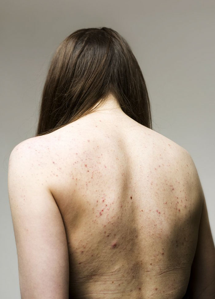 Women-Skin-Problems-Epidermis-Project-Sophie-Harris-Taylor