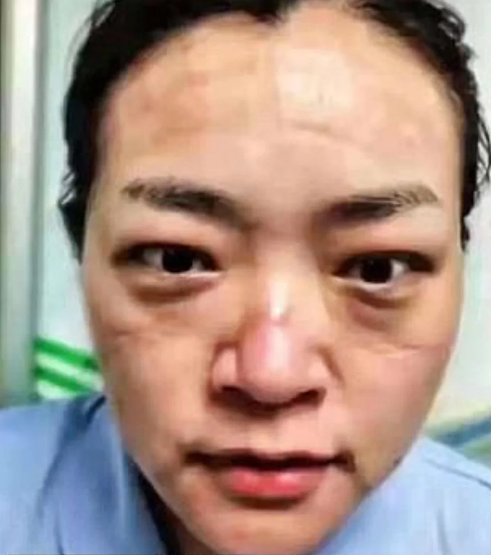 Estas enfermeras chinas muestran sus caras tras pasar incontables horas luchando contra el coronavirus