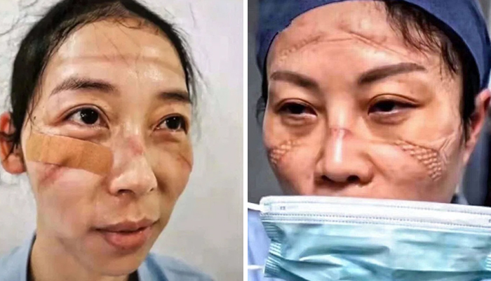 Chinese Nurses Share Pictures Of How Their Faces Look After Countless Hours Fighting The Coronavirus