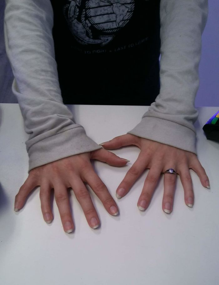 Customer Came In And Let Me Take A Picture Of Her Hands That Had 6 Fingers On Each