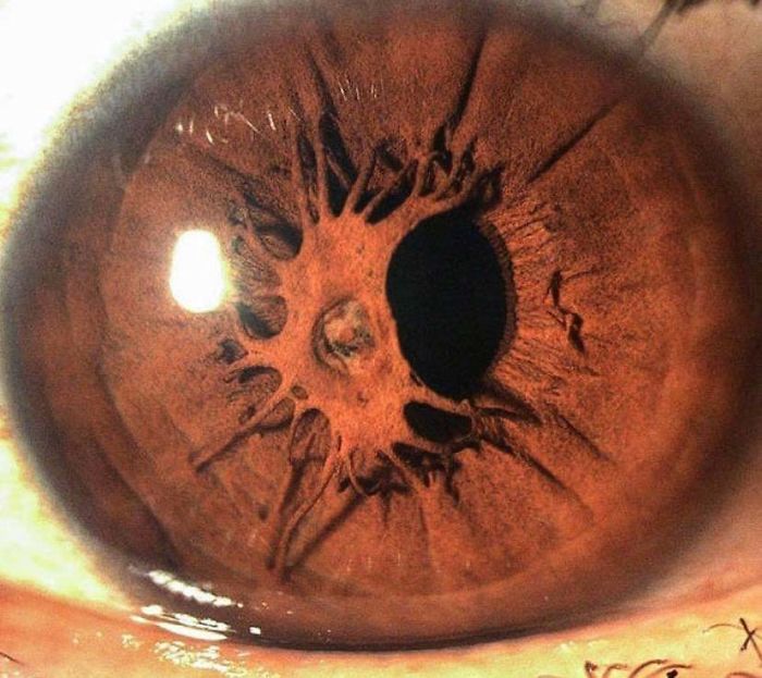 This Person Has An Iris Growing Over A Pupil
