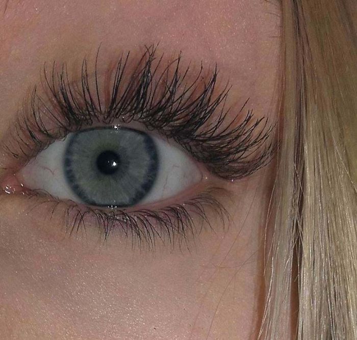 I Have A Condition Caused Distichiasis That Causes My Eyelashes To Grow In Multiple Rows