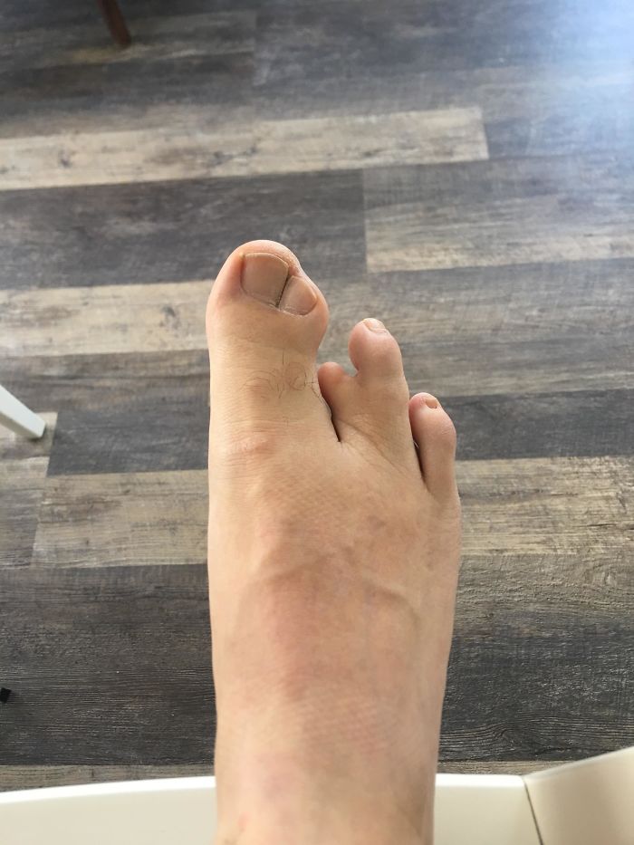 I Was Born With 3ish Toes On My Right Foot