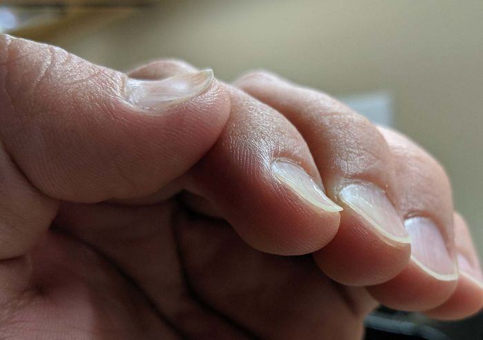 My Husband Has A Rare Genetic Mutation That Causes His Fingernails To Grow Inverted