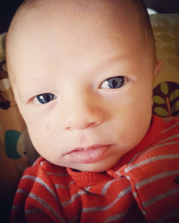 My Son Was Born With Coloboma In Both Eyes