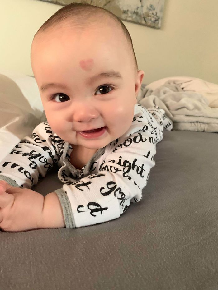 My Son's Amazing Birthmark