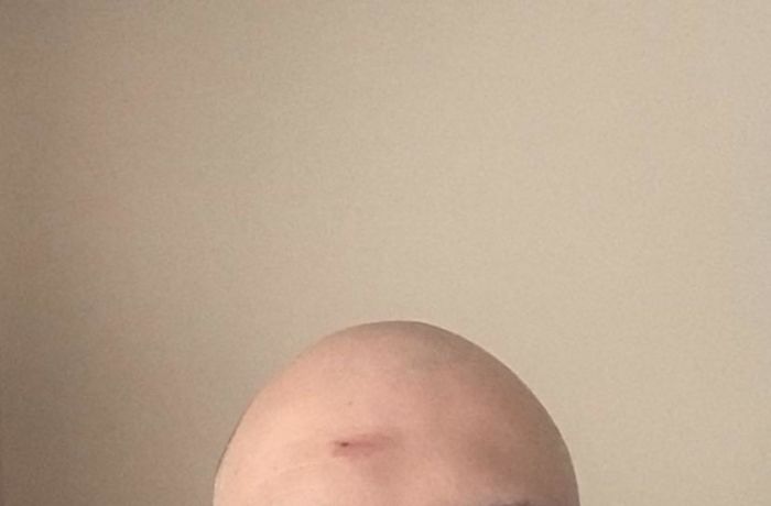 Since Gyms Are Closed, Decided To Do A Workout At Home. Cut My Head On A Doorframe Doing A Chin-Up. Good Thing I’m Completely Bald So It’s Even More Noticeable