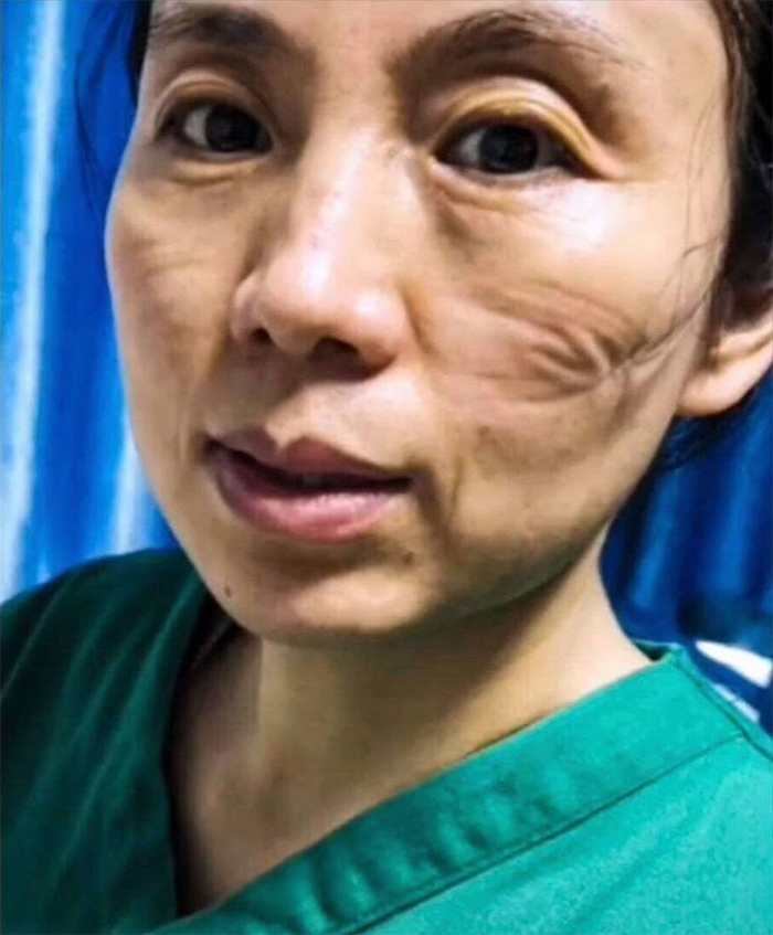 Nurse Takes A Selfie To Show What Wearing A Mask Does To Her Face