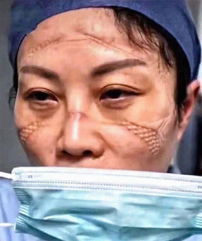 Nurse's Face After Taking Protective Gear Off