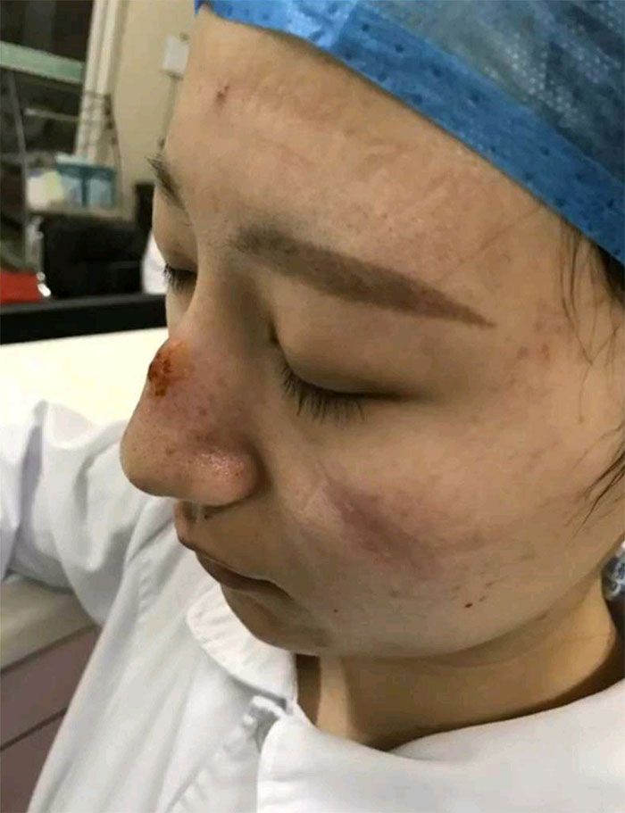 Gear Marks On Nurse's Face