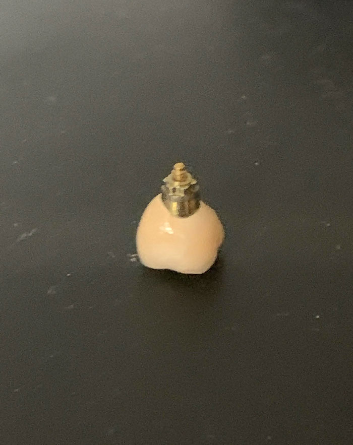 Dental Implant Just Fell Out And When I Called The Dentist I Was Told I Was Their “Last Call” As They Had Closed Until April 5th As Of 5 Minutes Ago
