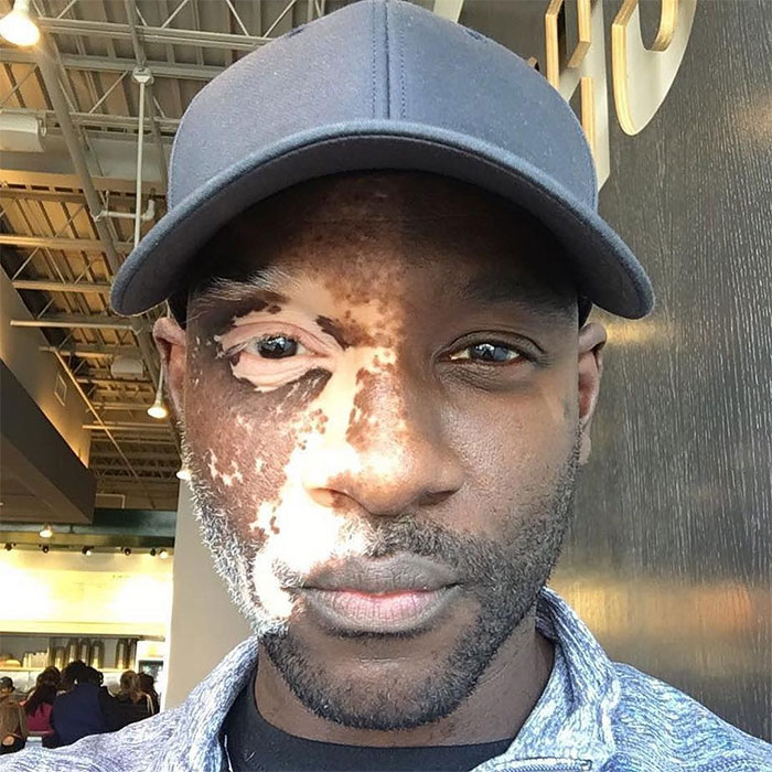 Vitiligo que afecta a un lado de su cara