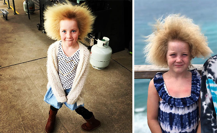 Uncombable Hair Syndrome Is Real: There Are Only About 100 People In The World Known To Have This Genetic Condition